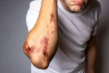 Man with a Large Abrasion Wound on his Arm
