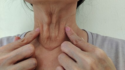 close up the flabbiness and wrinkle under the chin, neck wattle and Flabby skin, cellulite and fatty, loose and scar on the body of the woman, health care and beauty concept.