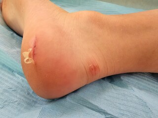 Healing of a wound on heel