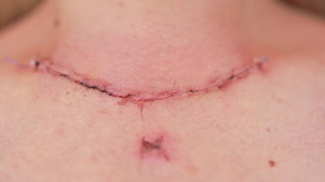 Scar after thyroidectomy. Surgical removal of the thyroid gland.