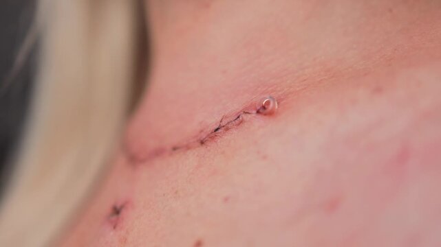 Scar after thyroidectomy. Surgical removal of the thyroid gland.