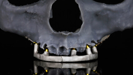 model of a resin skull with a dental bar in chrome cobalt on a black background