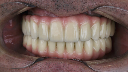 Mounted Dental Prosthetic of the upper and lower jaws with pink gums in the oral patient
