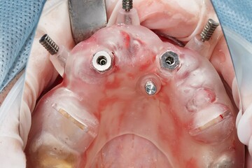 Fototapeta premium surgical dental template with two installed implants