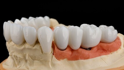 model of the upper jaw with a ceramic bridge and veneers for the upper jaw