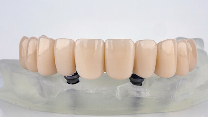 upper jaw prosthesis on a metal beam on a white background © Dental Pro Content