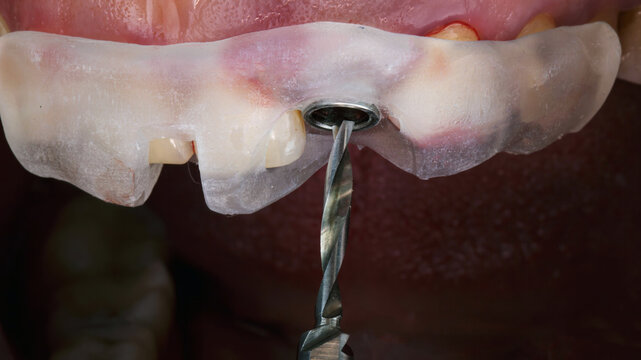 surgical dental cutter for bone preparation before implantation according to the template