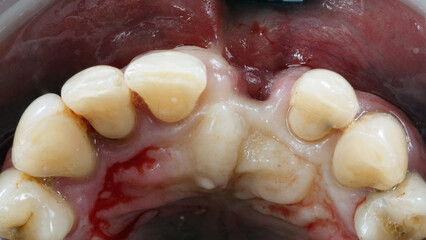 central tooth with lack of bone before implantation and bone grafting