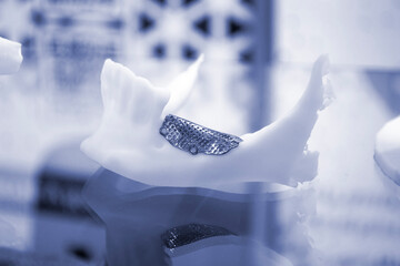 Prototype of lower human jaw with medical titanium implant from biocompatible titanium printed on 3D printer. Maxillo-facial prosthesis anatomical human bone from metal powder. Medicine medical