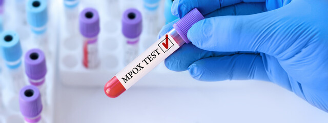 Doctor holding a test blood sample tube with Monkeypox virus (MPXV) .The virus is transmitted from...