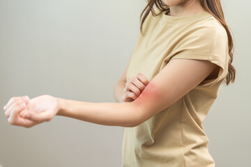Dermatology asian young woman, girl allergy, allergic reaction from atopic, insect bites on her...