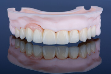 High-quality frontal dental bridge with artificial gum made of zirconium for fixation to upper jaw.