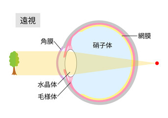 遠視のしくみをあらわした目の断面図2