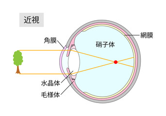 近視の仕組みをあらわした目の断面図1