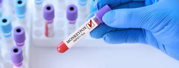 Obraz premium Doctor holding a test blood sample tube with Monkeypox virus (MPXV) .The virus is transmitted from animals to humans. Infected people suffer from fever, cough, headache, nausea and vomiting