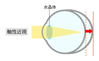 眼軸長を比較した軸性近視のシンプルなイラスト