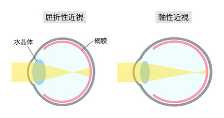 屈折性近視と軸性近視のシンプルな比較イラスト