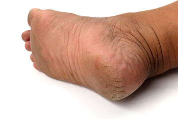 Fototapeta premium cracked heel, isolated on white background, Dry and cracked soles of feet