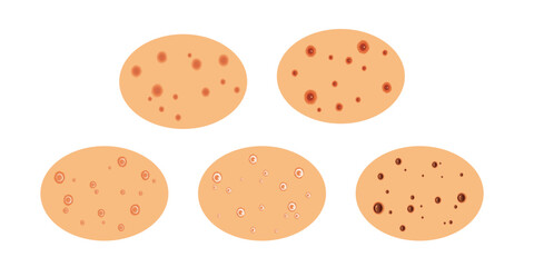 Fototapeta premium The Progressive Spread of Mpox: Stages of the Growing Disease.
