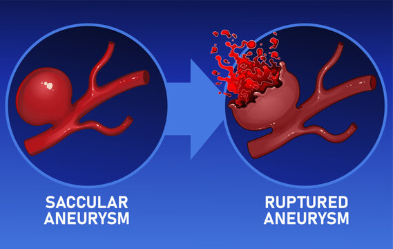The rupture of aortic aneurysms. Healthcare illustration. Vector illustration.