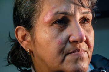 Obraz premium Healthcare and medicine: Hispanic mature woman suffering from the skin chronic disease rosacea.
