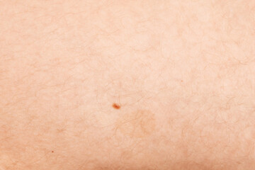 Fototapeta premium A close-up of skin with small moles, perfect for dermatology, skincare, or medical-themed projects.
