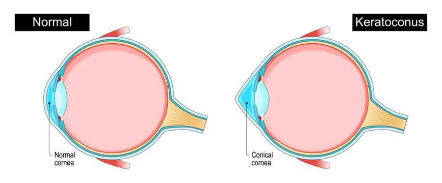 Keratoconus. Eye disorder. Corneal thinning. Progressive eye disease.