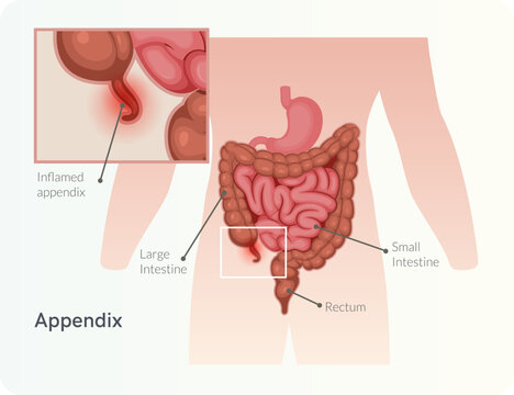  Appendicitis - Inflamed Appendix - Stock Illustration