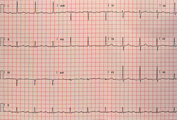 Electrocardiogram in paper form. Analog electrocardiographic recording. ECG example.