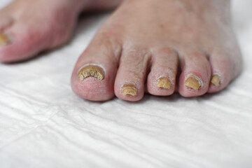 Skin damage, a wound on a woman's legs. Diseases of the skin. Damage to the nail plate, nail by a fungal disease