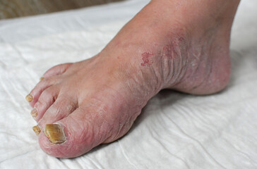 Skin damage, a wound on a woman's legs. Diseases of the skin. Damage to the nail plate, nail by a fungal disease