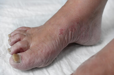 Skin damage, a wound on a woman's legs. Diseases of the skin. Damage to the nail plate, nail by a fungal disease