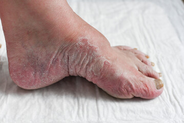Skin damage, a wound on a woman's legs. Diseases of the skin. Damage to the nail plate, nail by a fungal disease