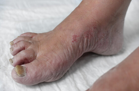 Skin damage, a wound on a woman's legs. Diseases of the skin. Damage to the nail plate, nail by a fungal disease