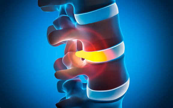 Human Spine Disc Degeneration - Spine Problems - 3D illustration