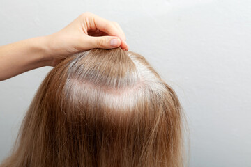 Showing grey hair roots, closeup. Going gray in young woman. Hair getting grey. Problem of early...