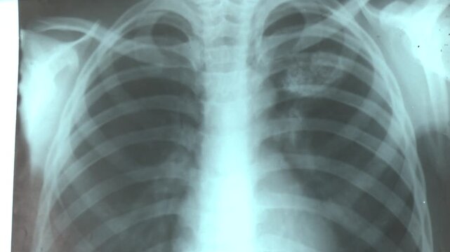 Pleural effusion in chest x-ray, A pleural effusion is a collection of fluid in the pleural space. Classical projection chest radiographic examination.