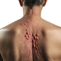 Naklejka premium Male back affected by blistering rash because of monkeypox or other viral infection. png isolated background. transparent background