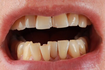 
Man demonstrating his two front Incisors teeth that are chipped
