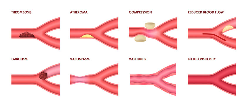 Vein diseases of thrombosis, atheroma and vasculitis with blood viscosity, vector medical infographic icons. Vein diseases of vascular artery compression, vasospasm, embolism and reduced blood flow