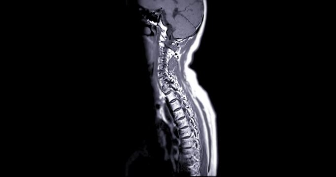 MRI of C-spine or magnetic resonance image of cervical spine sagittal view for diagnosis spondylosis and compression fracture.