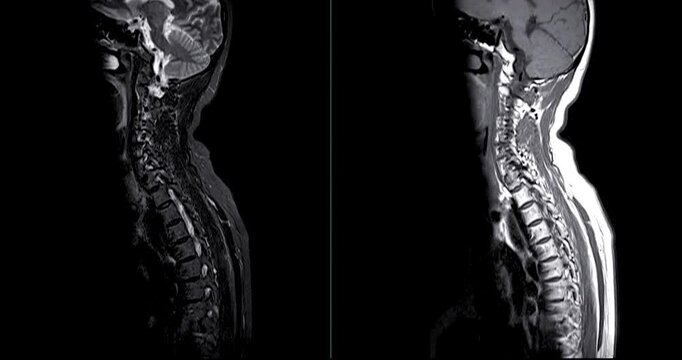 MRI of C-spine or magnetic resonance image of cervical spine sagittal view for diagnosis spondylosis and compression fracture.