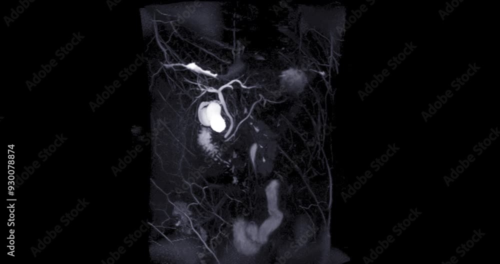Poster magnetic resonance cholangiopancreatography or mrcp 3d mip view showing visualize the biliary and pa