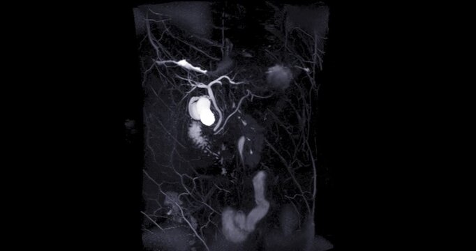 Magnetic resonance cholangiopancreatography or MRCP 3D  MIP view showing visualize the biliary and pancreatic ducts .