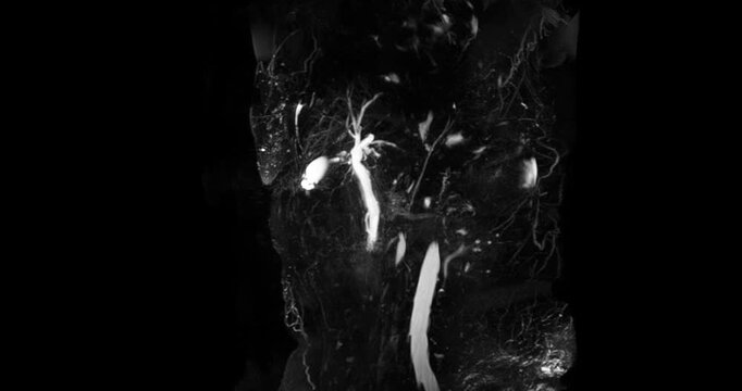 Magnetic resonance cholangiopancreatography or MRCP 3D  MIP view showing visualize the biliary and pancreatic ducts .