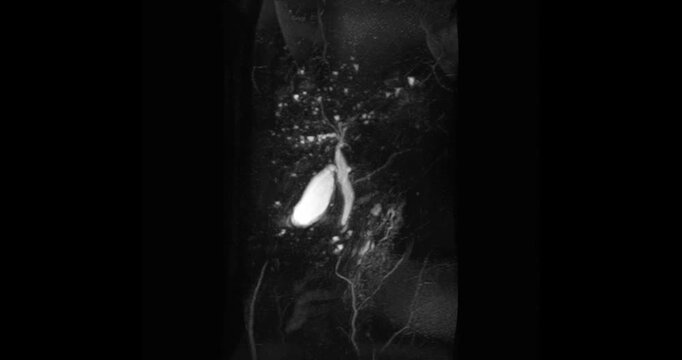 Magnetic resonance cholangiopancreatography or MRCP 3D  MIP view showing visualize the biliary and pancreatic ducts .