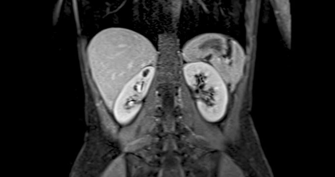 MRI abdomen coronal views are particularly useful for assessing liver, kidneys, and other abdominal organs with precision.