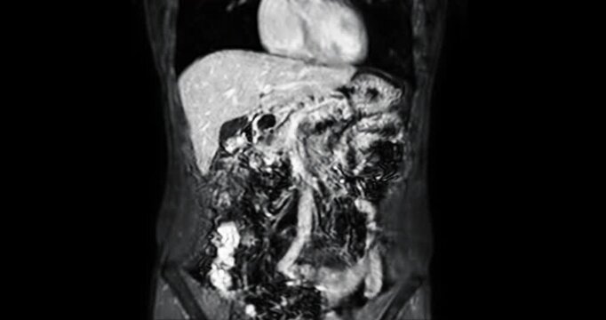 MRI abdomen coronal views are particularly useful for assessing liver, kidneys, and other abdominal organs with precision.