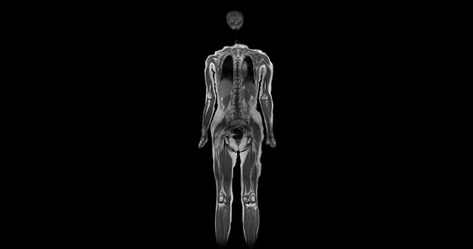 MRI whole body scans are beneficial for early cancer detection, monitoring chronic conditions, and overall health assessments.