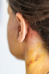 Fototapeta premium Shot of the stitches and scars on woman head after cosmetic surgery. Healthcare